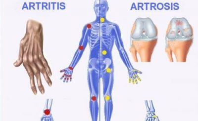diferencia entre artritis y artrosis